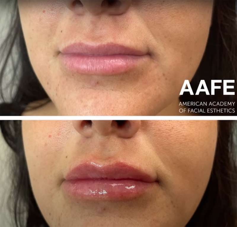 Lip filler before after photo