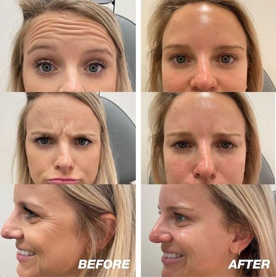Botox before after photos
