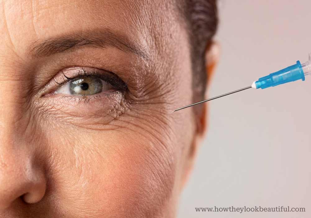 Botox can be injected into the crow’s feet around eyes