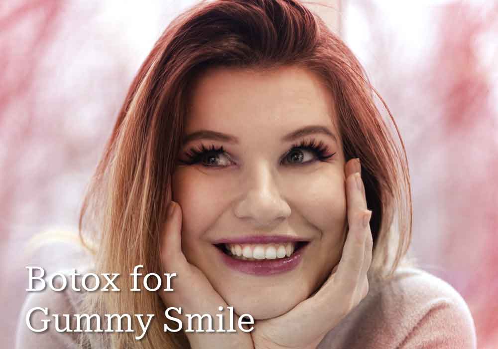 Botox for gummy smile
