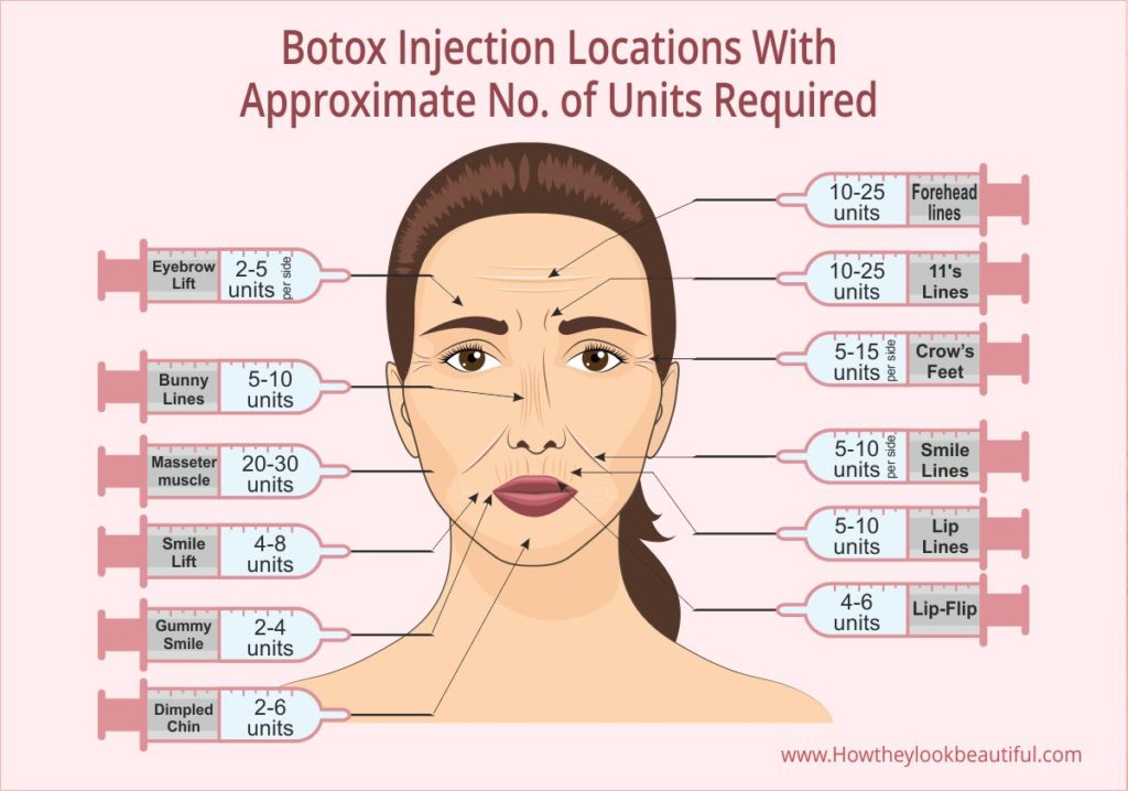 Botox Injection Sites on the Face