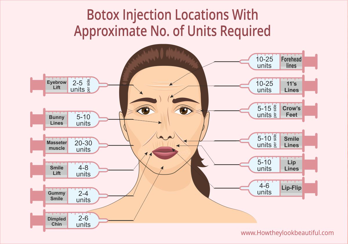 Where on Your Face Can You Get Botox Injected? (With Units)