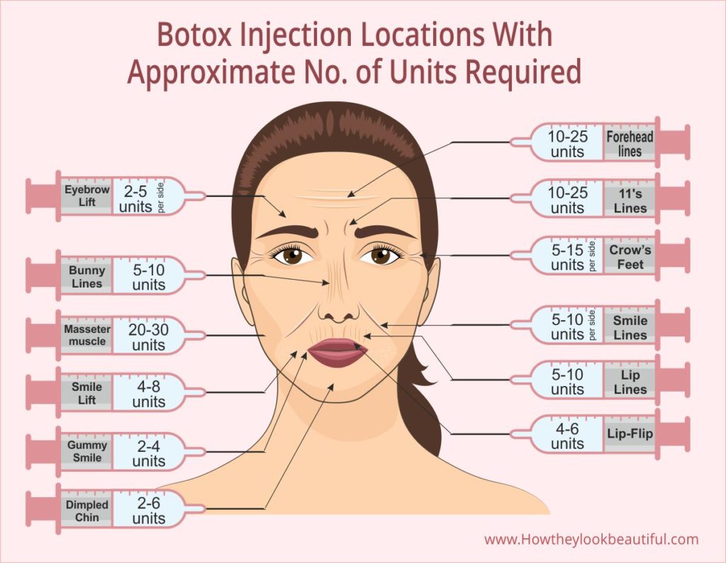Botox Injection Sites on the Face