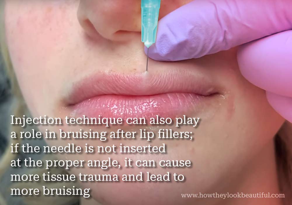 bruising-after-lipfillers