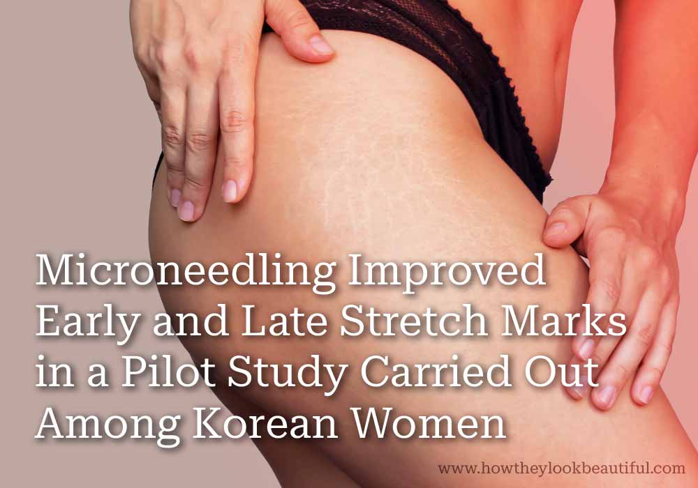 Effectiveness of Microneedling on stretch marks