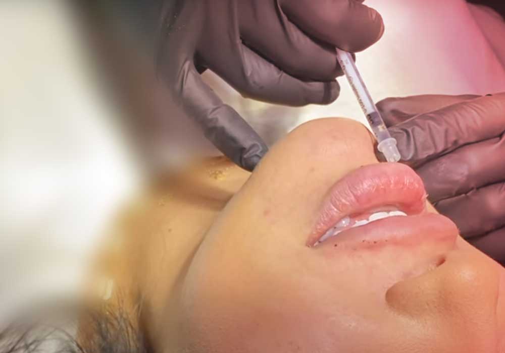 Doctor giving lip filler injection