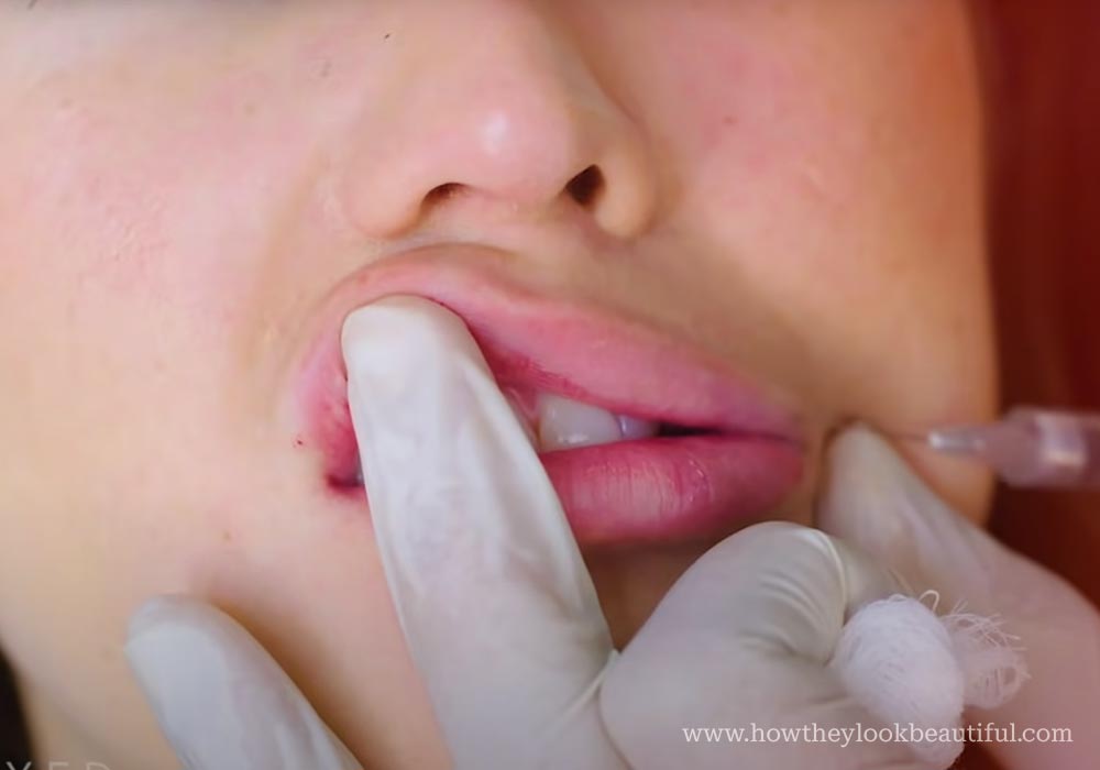 Lip filler injection