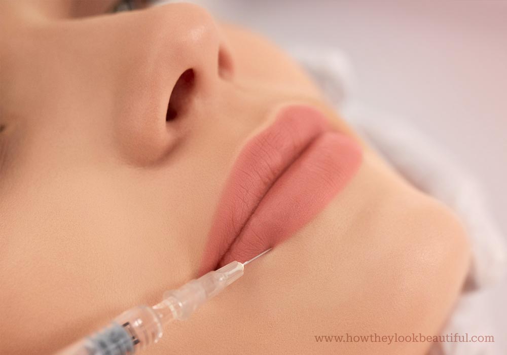 Closeup of Performing lip filler injection