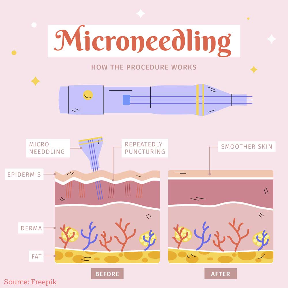 microneedling procedure diagram