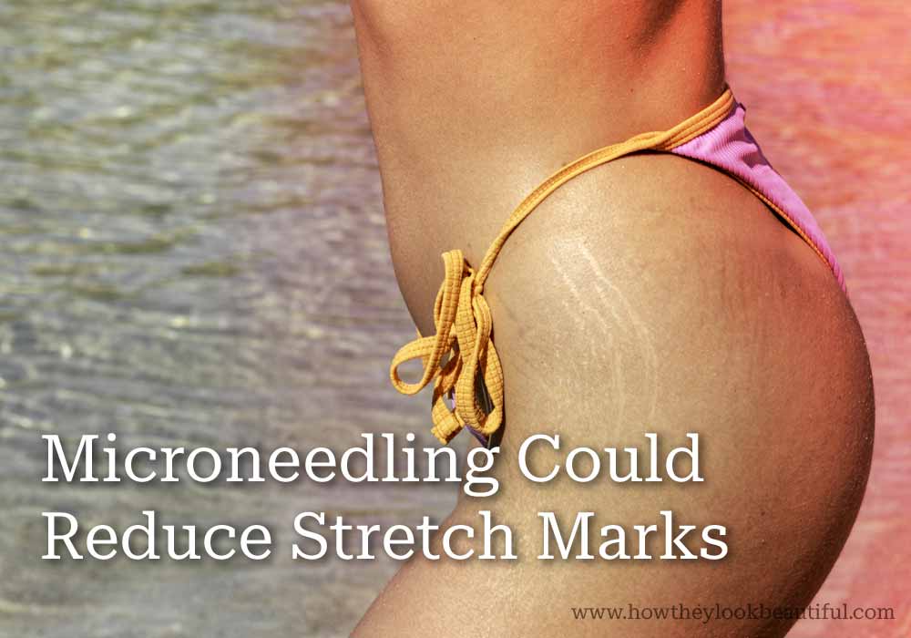 microneedling-reduces-stretchmarks