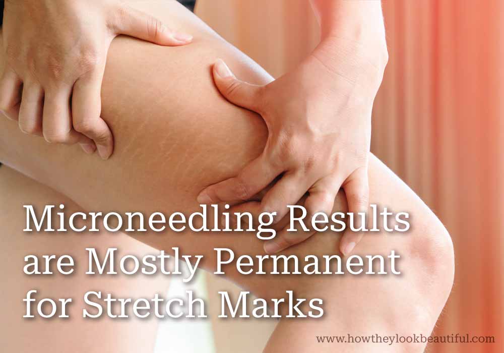 microneedling-results-stretch-marks
