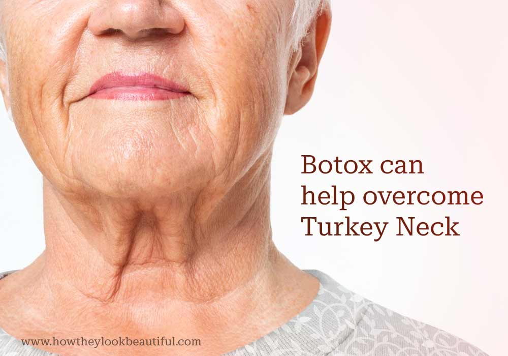 Botox can help Turkey Neck